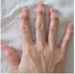 指の第一関節が痛く変形してくるヘパーデン結節の治し方